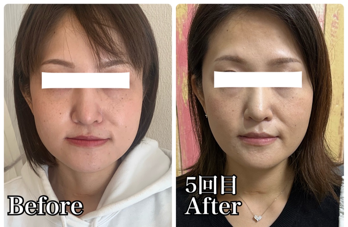 30代女性の施術前後の比較写真