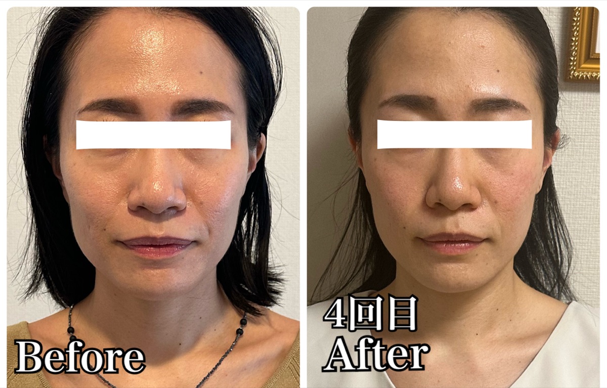 30代女性の施術前後の比較写真