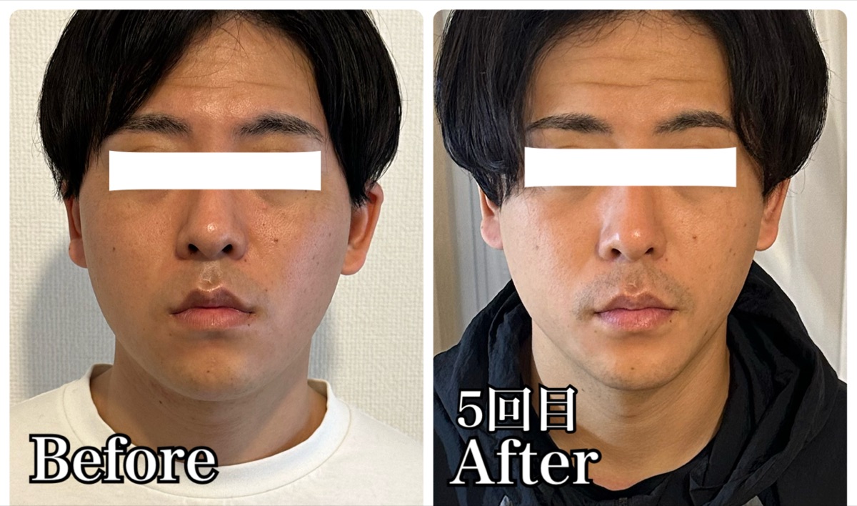 30代男性の施術前後の比較写真
